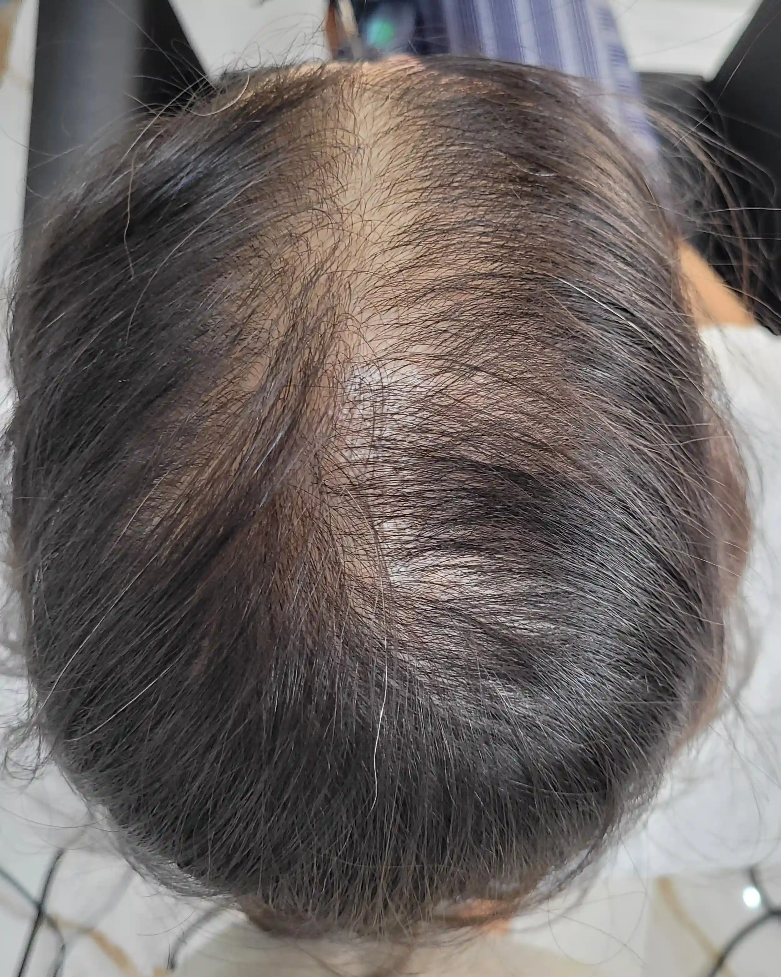 Antes e depois — tratamento de queda capilar em 5 Sessões — Rapha Beauty Tatuapé (Antes)